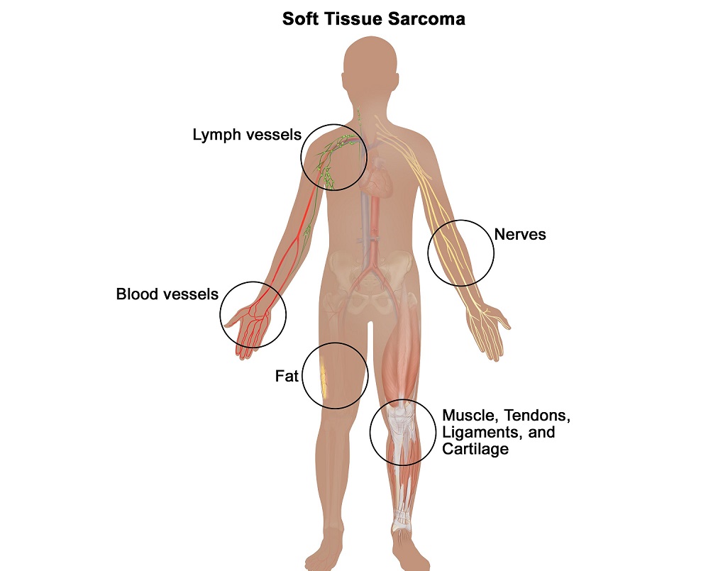 Soft Tissue Sarcoma