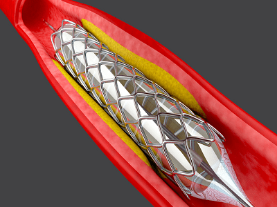 Stent Market