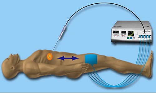 Ablation System Devices Market to Grow at a Significant Rate During the Forecast PeriodAblation System Devices Market