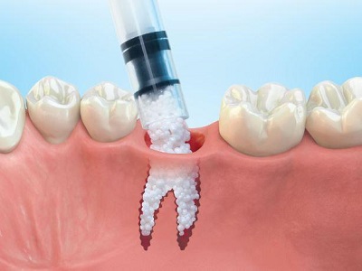 Dental Bone Graft Substitute Market - TechSci Research