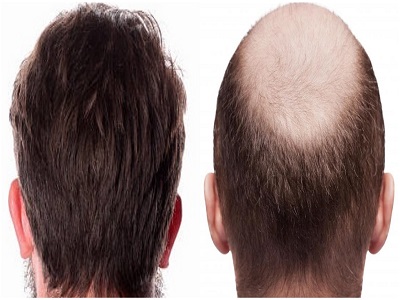 Hair Restoration Market