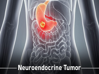 Neuroendocrine Tumor Market - TechSci Research