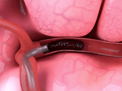 Neurothrombectomy Devices Market - TechSci Research