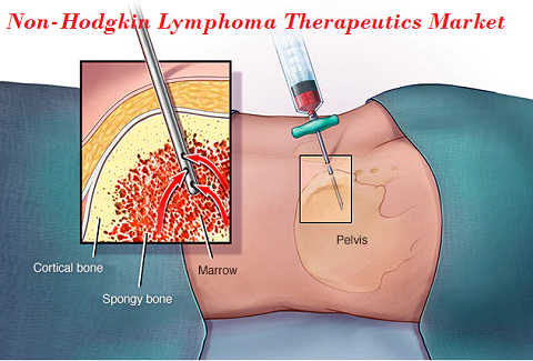 Global Non-Hodgkin Lymphoma Therapeutics Market