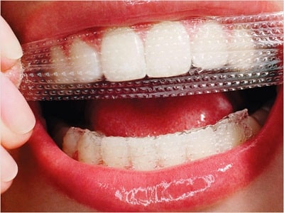 Teeth Whitening Strips Market - TechSci Research