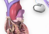 UAE Cardiovascular Devices Market